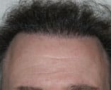 Hair Transplant Before and After Pictures Indianapolis, IN