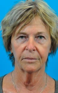 Juvederm® Voluma XC Before and After Pictures Indianapolis, IN