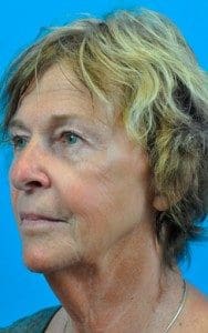 Juvederm® Voluma XC Before and After Pictures Indianapolis, IN