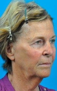 Juvederm® Voluma XC Before and After Pictures Indianapolis, IN