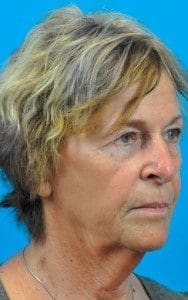 Juvederm® Voluma XC Before and After Pictures Indianapolis, IN
