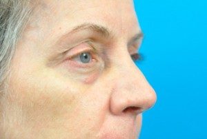 Juvederm® Voluma XC Before and After Pictures Indianapolis, IN