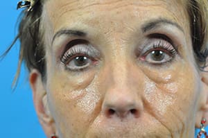 Juvederm® Voluma XC Before and After Pictures Indianapolis, IN