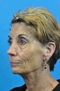 Juvederm® Voluma XC Before and After Pictures Indianapolis, IN