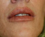 Juvederm® Voluma XC Before and After Pictures Indianapolis, IN