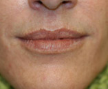 Lip Augmentation Before and After Pictures Indianapolis, IN
