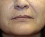 Juvederm® Voluma XC Before and After Pictures Indianapolis, IN