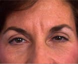 Botox Before and After Pictures Indianapolis, IN