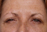 Botox Before and After Pictures Indianapolis, IN
