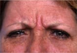 Botox Before and After Pictures Indianapolis, IN