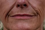 CO2 Laser Before and After Pictures Indianapolis, IN