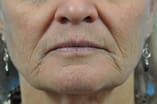 CO2 Laser Before and After Pictures Indianapolis, IN