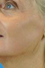 CO2 Laser Before and After Pictures Indianapolis, IN