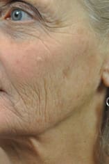 CO2 Laser Before and After Pictures Indianapolis, IN