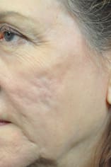CO2 Laser Before and After Pictures Indianapolis, IN