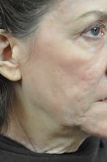CO2 Laser Before and After Pictures Indianapolis, IN