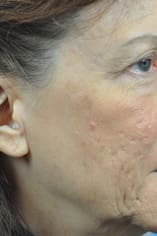 CO2 Laser Before and After Pictures Indianapolis, IN