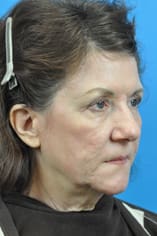 CO2 Laser Before and After Pictures Indianapolis, IN