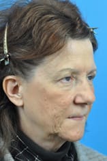 CO2 Laser Before and After Pictures Indianapolis, IN