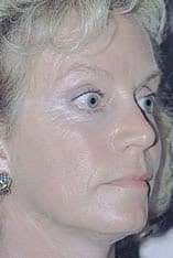 CO2 Laser Before and After Pictures Indianapolis, IN