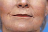 CO2 Laser Before and After Pictures Indianapolis, IN