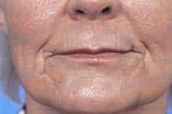 CO2 Laser Before and After Pictures Indianapolis, IN