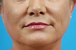CO2 Laser Before and After Pictures Indianapolis, IN