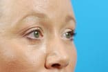 CO2 Laser Before and After Pictures Indianapolis, IN