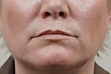 CO2 Laser Before and After Pictures Indianapolis, IN