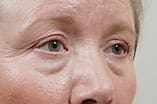 CO2 Laser Before and After Pictures Indianapolis, IN
