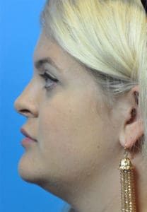 Rhinoplasty Before and After Pictures Indianapolis, IN