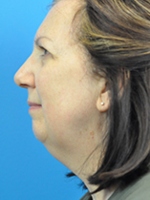 Chin Implant Before and After Pictures Indianapolis, IN