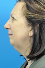 Facelift Before and After Pictures Indianapolis, IN