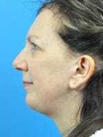Chin Implant Before and After Pictures Indianapolis, IN