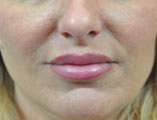 Lip Augmentation Before and After Pictures Indianapolis, IN