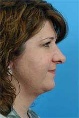 Facial Liposuction Before and After Pictures Indianapolis, IN