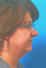 Facial Liposuction Before and After Pictures Indianapolis, IN