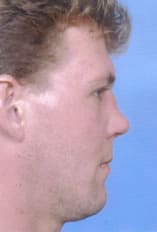 Rhinoplasty Before and After Pictures Indianapolis, IN