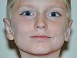 Otoplasty Before and After Pictures Indianapolis, IN