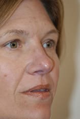 Rhinoplasty Before and After Pictures Indianapolis, IN
