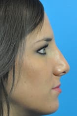 Rhinoplasty Before and After Pictures Indianapolis, IN