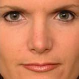 Rhinoplasty Before and After Pictures Indianapolis, IN