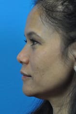 Rhinoplasty Before and After Pictures Indianapolis, IN