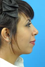 Rhinoplasty Before and After Pictures Indianapolis, IN