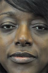 Rhinoplasty Before and After Pictures Indianapolis, IN