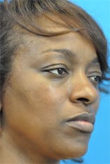 Rhinoplasty Before and After Pictures Indianapolis, IN