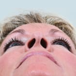 Rhinoplasty Before and After Pictures Indianapolis, IN