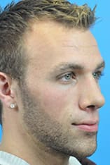 Rhinoplasty Before and After Pictures Indianapolis, IN