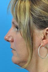 Rhinoplasty Before and After Pictures Indianapolis, IN