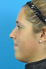 Rhinoplasty Before and After Pictures Indianapolis, IN